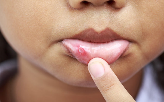 What is a Canker Sore?